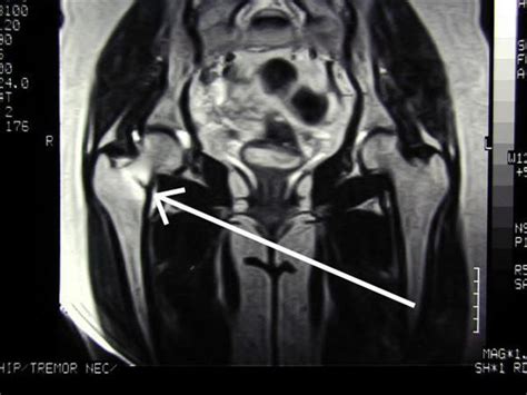 Femoral Neck Stress Fractures Knee And Sports Orthobullets