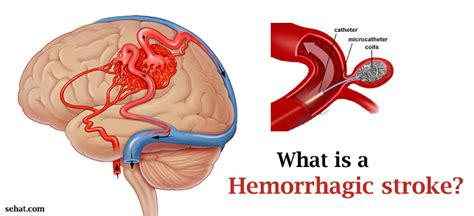 Hemorrhagic Stroke Causes Symptoms Prognosis And Treatment Health