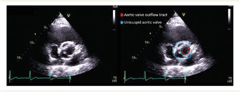 Figure 1 From Unicuspid Aortic Valve Replacement With Development Of