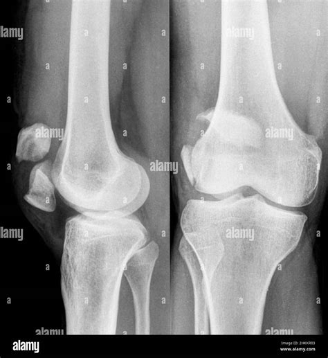 Kneecap Fracture X Ray Stock Photo Alamy