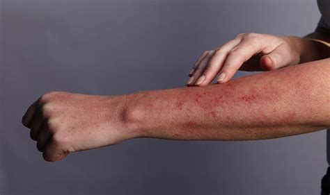 Also known as prickly heat, prickly heat rash, miliaria, or red miliaria; How to get rid of heat rash: Relieve redness and itchiness ...