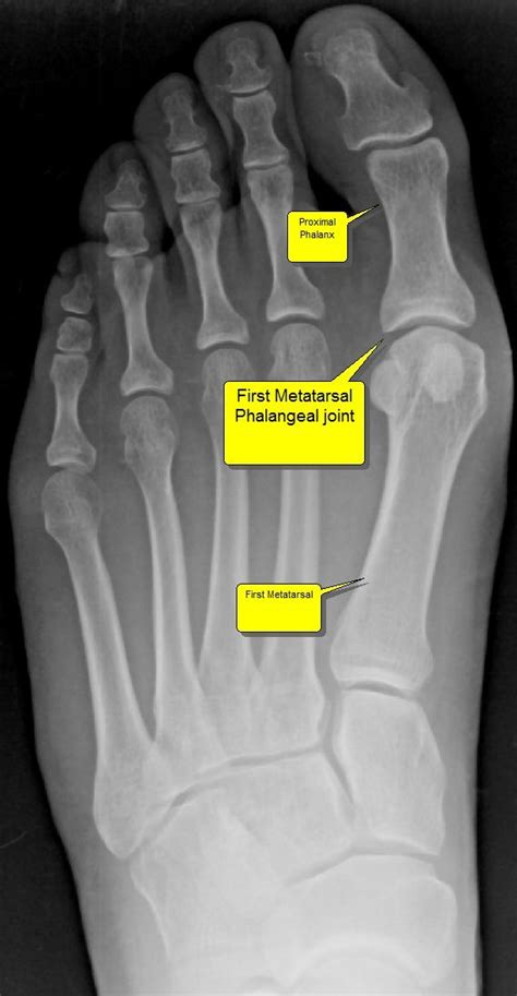 Hallux Limitus Surgery Pain In The Big Toe Joint Is One Of The Most