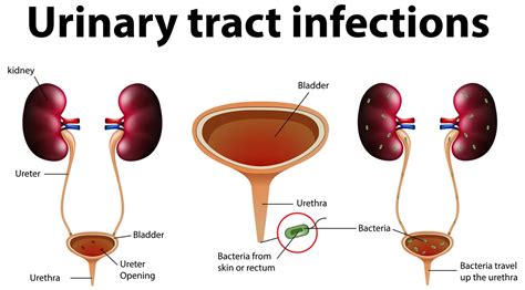 Urinary Tract Infections Symptoms Diagnosis And Treatment Urinary Tract Issues Medical
