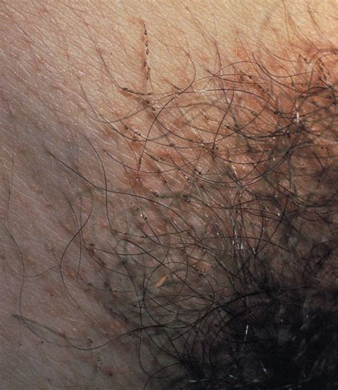 Moisten the pubic hair and skin by soaking in a bathtub of warm water for at least five minutes before shaving. Image: Pediculosis Pubis (Pubic Lice) With Nits Attached to Pubic Hair - Merck Manuals ...