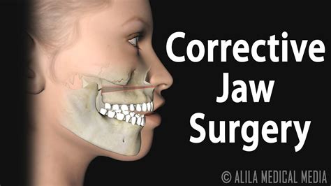 Corrective Jaw Orthognathic Surgery Animation Youtube