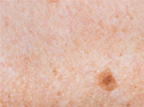 Birthmarks Pigmented As Related To Acne Pictures