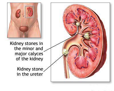 There are 213 kidney stone humor for sale on etsy, and they cost $17.02 on average. Is Homeopathy Treatment Effective for Kidney Stones?