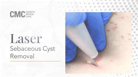 Laser Sebaceous Cyst Removal Cosmetic Medical Clinic Cmc Nsw Youtube
