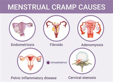 Severe Menstrual Cramps Vein Endovascular Medical Care