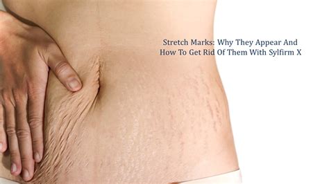 Stretch Marks Why They Appear And How To Get Rid Of Them With Sylfirm