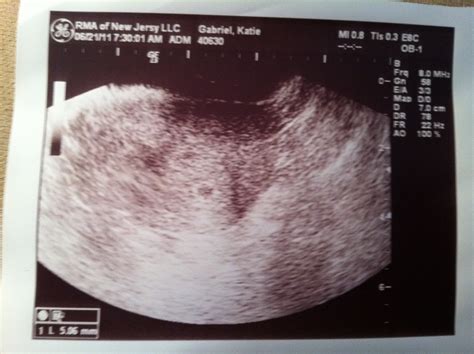 Plus, find out about what exactly goes on inside of you during this early stage of pregnancy. Dear Hope: Ultrasound Pictures