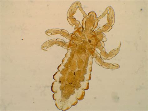 Head Lice Guide Causes Symptoms And Treatment Options