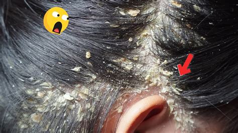 Dandruff Scratching Itchy Dry Scalps Psoriasis Huge Flakes Removal