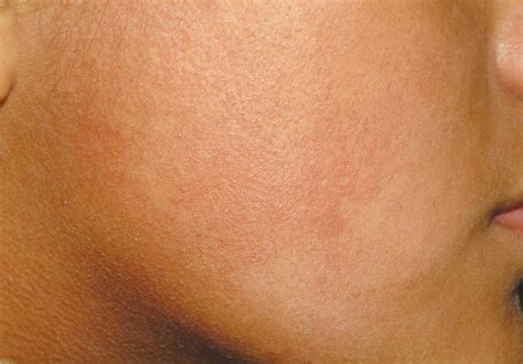 Keratosis Pilaris