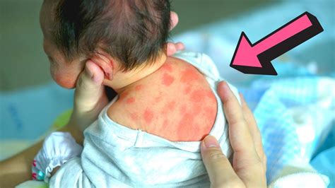 What Is Newborn Rash And How You Can Help It Youtube