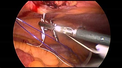 Laparoscopic Repair Of Pfannenstiel Incision Induced Hernia Youtube