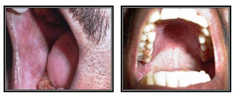 Erythroplakia is rare compared to oral leukoplakia. Oral Cancer: Risk Factors Part 3 and Symptoms ...