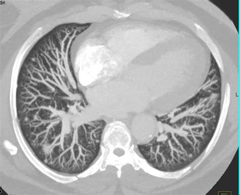 Pulmonary Nodules Best Seen On Mip Imaging Chest Case Studies