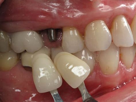 Check spelling or type a new query. Broken Tooth - Slanted Dental Implant Crown Fixed - Dental ...