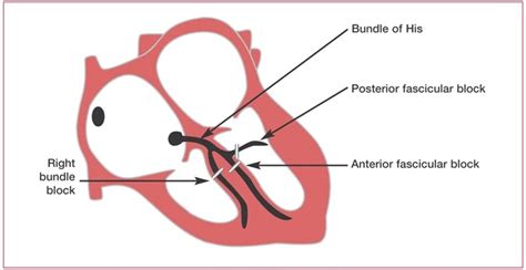 Phimaimedicine 644 Fascicular Block