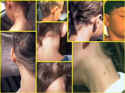 Lyme Disease Swollen Lymph Nodes Neck Captions Beautiful