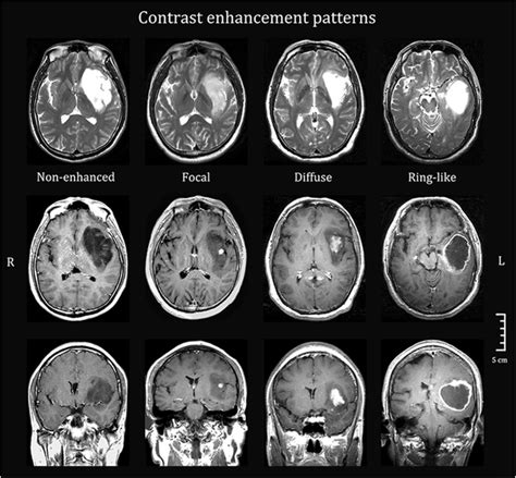 Representative Images Of Different Tumor Contrast Enhancement Patterns