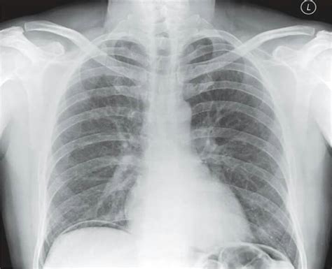 Chest X Ray Pa View Showing Gas Under The Diaphragm Bilaterally With