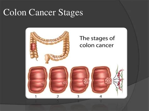 Colon Cancer Stagestypes