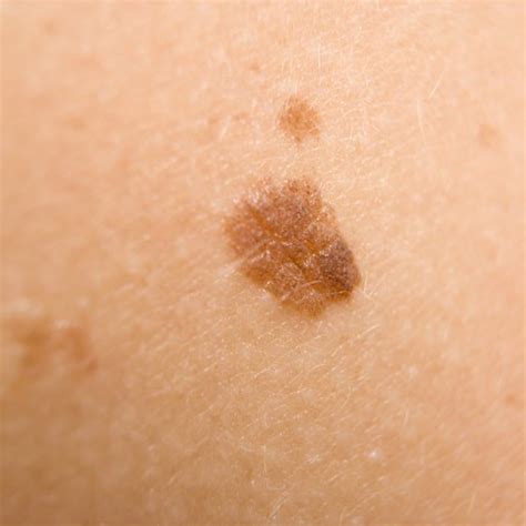 How To Recognize Signs Of Skin Cancer Healthy Living