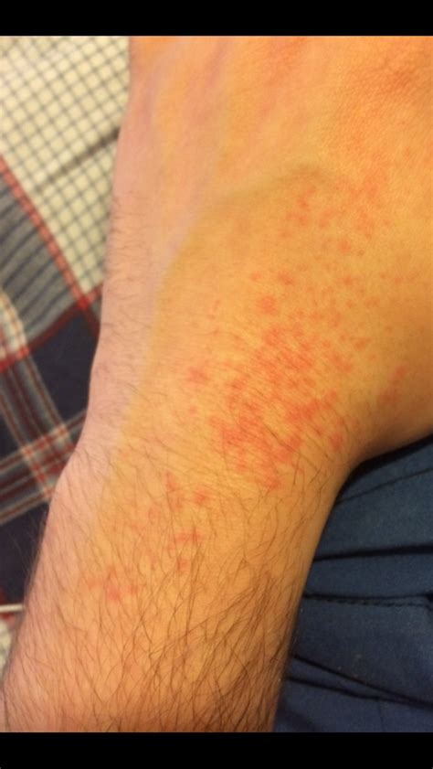 Id Does This Look Like A Bed Bug Induced Rash Please Help Bedbugs