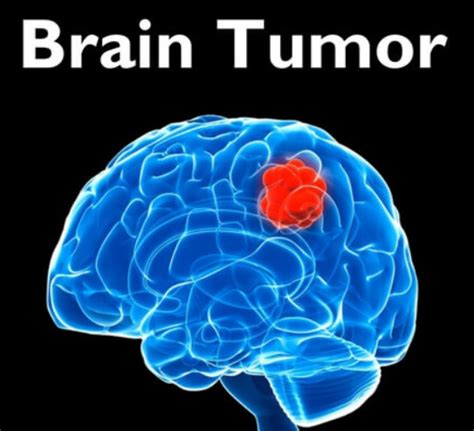 Gliomas for examples are primary brain tumors. Brain Tumor Can Strike At Any Age, Be Observant