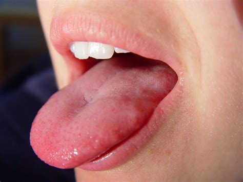 Early Symptoms Of Tongue Cancer Ebuddynews