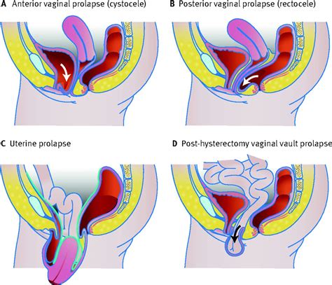 On this brain ct, we see a hamer focus in the uterus relay (view the gnm diagram). Pelvic organ prolapse | The BMJ