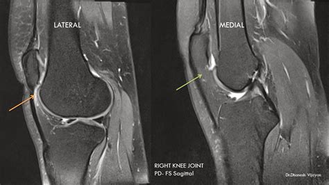 Ultimate Radiology Hoffas Fat Pad Impingement Syndrome