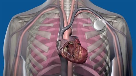 What Is Fluid Monitoring For Heart Failure Youtube