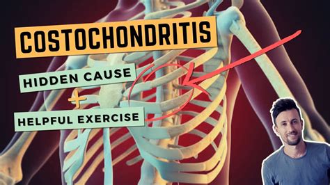 Costochondritis The Hidden Cause And A Simple Exercise To Fix Anterior