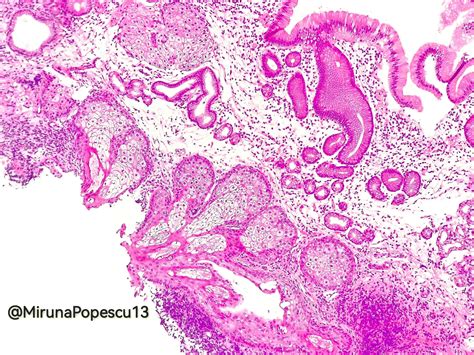 Pathology Outlines Heterotopic Ectopic Sebaceous Glands