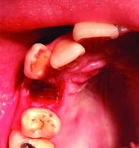 Clot Formation Inside The Tooth Socket After Laser Treatment Download