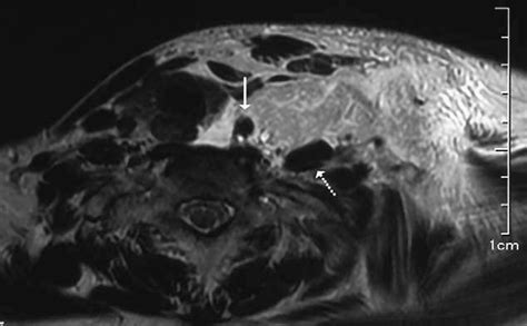 Figure 2 From A Case Of Idiopathic Lymph Leakage In The Neck