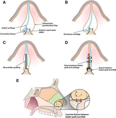 Figure 1 From How To Resolve The Caudal Septal Deviation Clinical