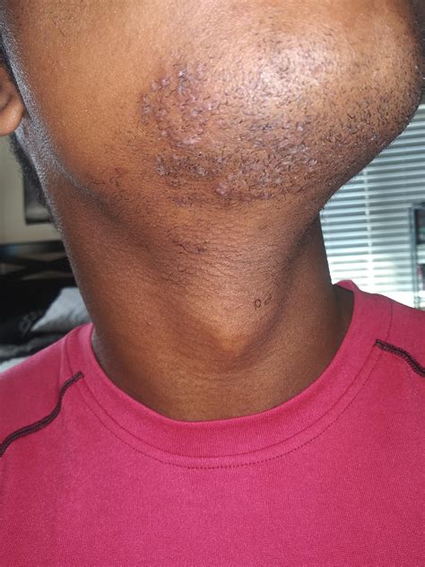 Doesn't seem like I can ever get rid of these razor bumps ...