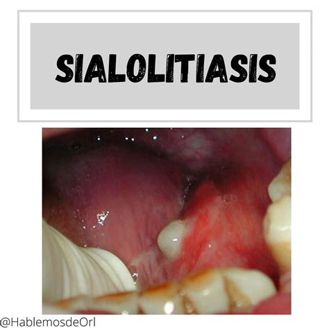 Enfermedad Infecciosa Email Cumplir Calculos Salivales Sílaba