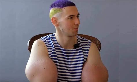 That Delusional Russian Synthol Kid Might Really Need His Arms Amputated