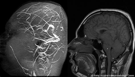 Dr Balaji Anvekar Frcr Brachial Plexitis Mri