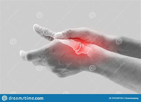 Arthritis Of Thumb Joint Stock Photo Image Of Fingertips 270169734