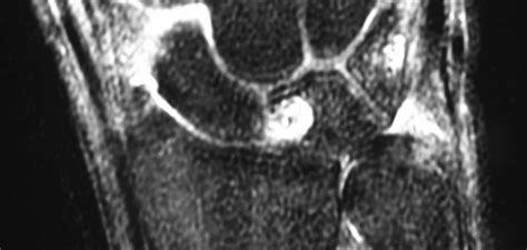A Cyst In Lunate And Fluid Around Scaphoid Radiopaedia