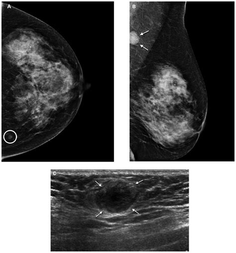 Plasmacytoma Of The Breast Left Mammogram Shows A A Small Well