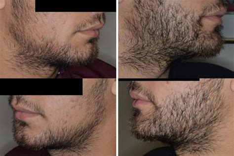 Beard Transplant Miami Fl Dr Anthony Bared