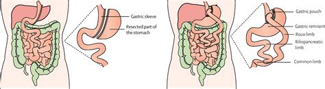 Adaptations In Gastrointestinal Physiology After Sleeve Gastrectomy And Roux En Y Gastric Bypass