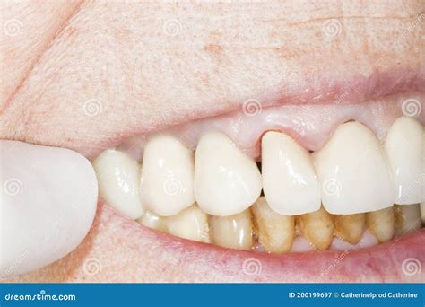 Woman Teeth Before And After Whitening Imperfect Dentition Stock Image Image Of Healthy Lady